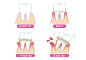 健康的な歯と歯周病の歯