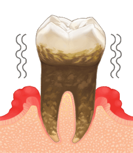重度の歯周病イラスト