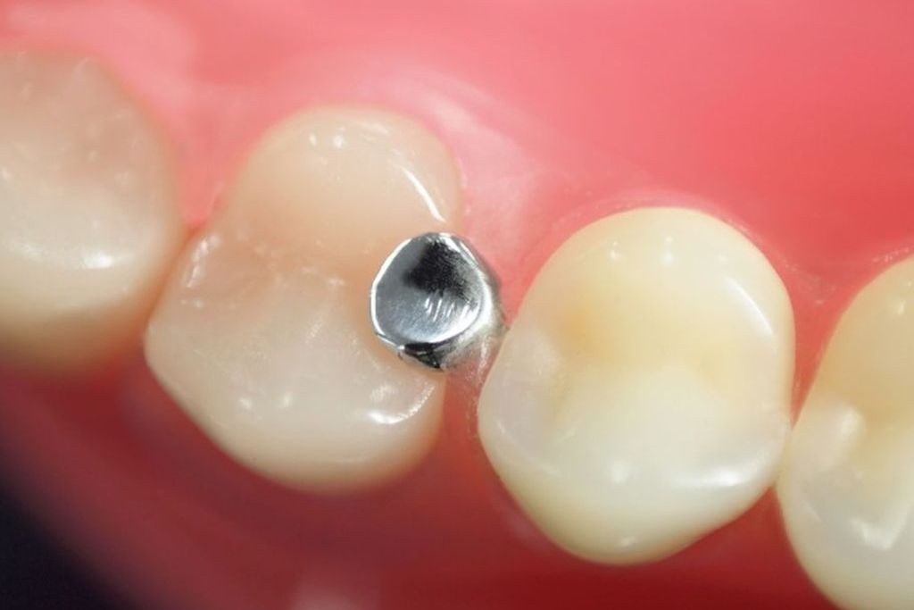 銀歯を白い歯に替える人が多い理由