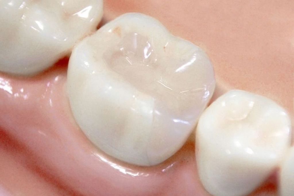 保険診療の白い歯